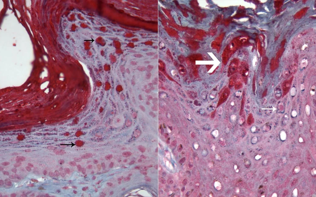 Caso-Junio–Agosto-2011. Placa Dérmica Pigmentada