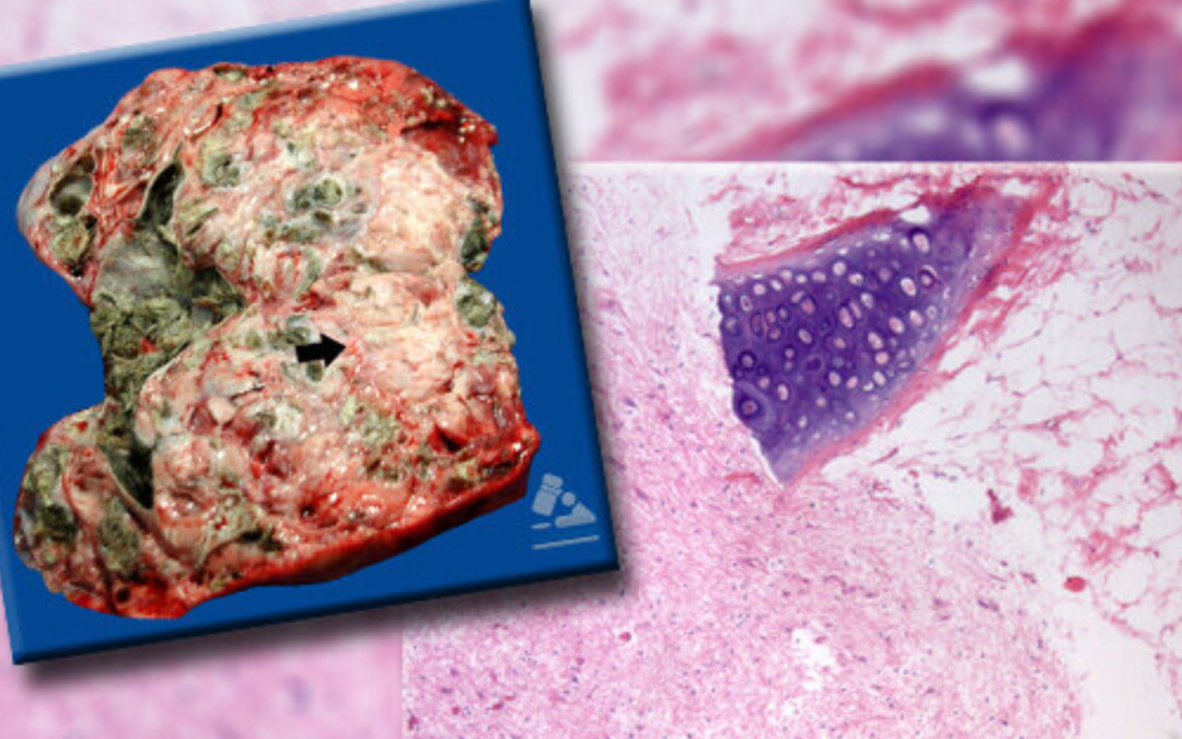 Mayo-Julio-2015.Teratoma
