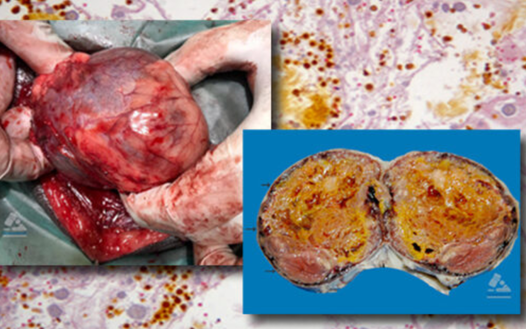 Enero-Junio,2018. Hematoma Abdominal