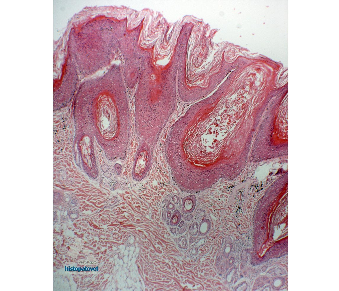 Fig.1. Observe el engrosamiento de la epidermis. Además hay una ortoqueratosis.