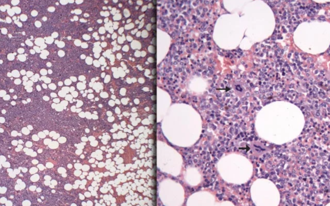 Octubre–Diciembre-2013. Mielolipoma