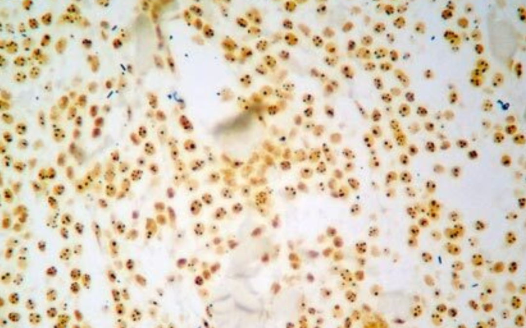 Julio–Setiembre-2012. Mastocitoma subcutaneo