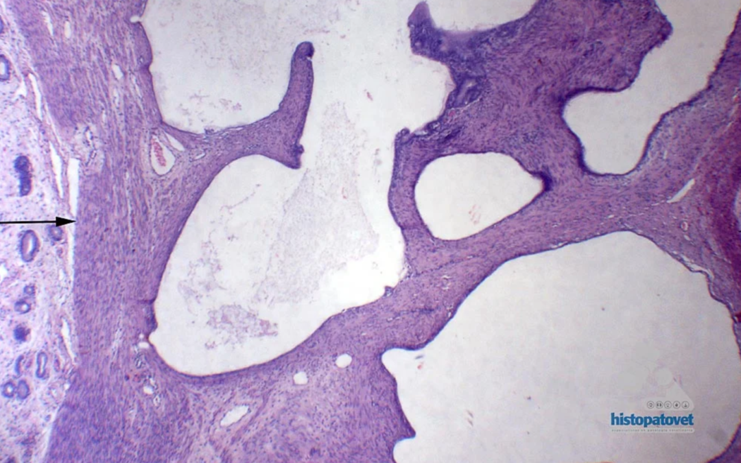 Marzo-Mayo 2014-Adenomiosis